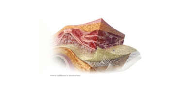 Gore Synecor Intraperitoneal biyomateryali piyasaya sürdü